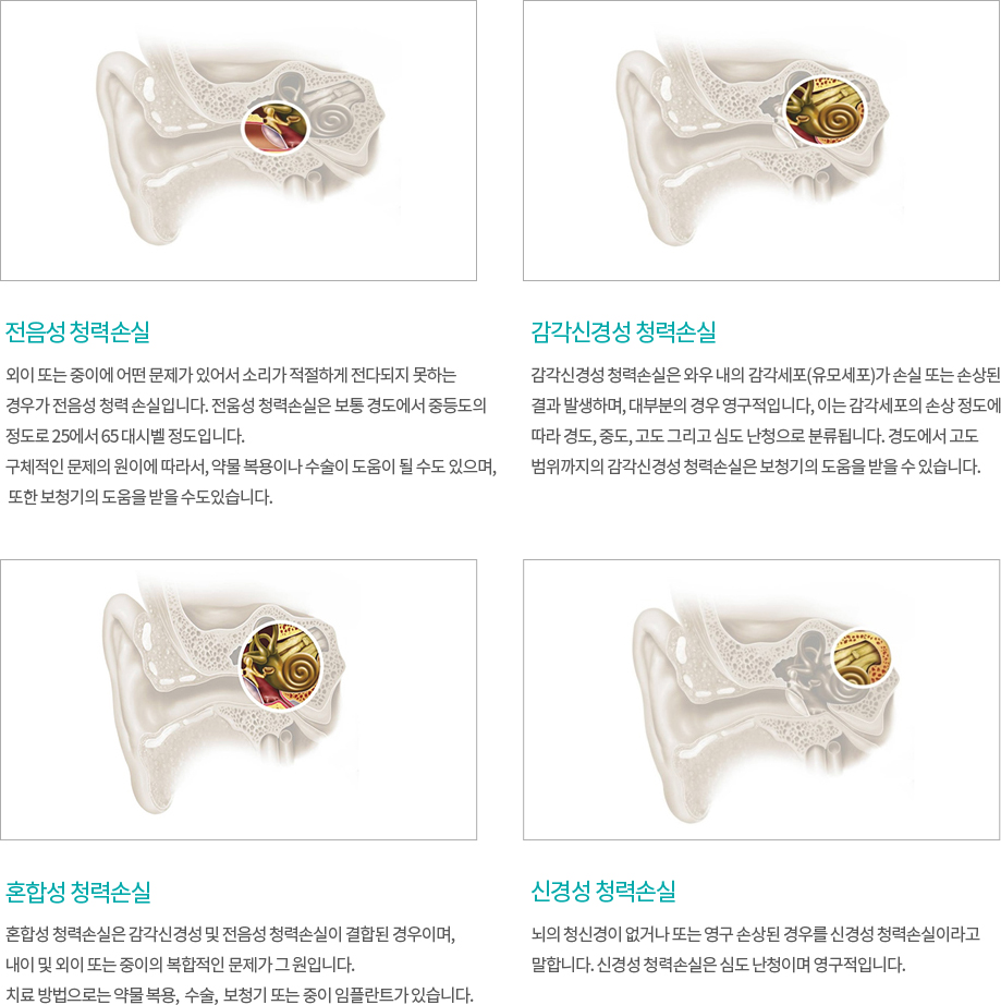외이·중이·내이와 청각신경의 관련 부위를 표시한 난청 유형 안내